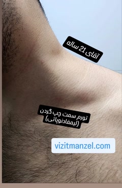 تشخیص علت تورم کنار گردن توسط دکتر خنجری