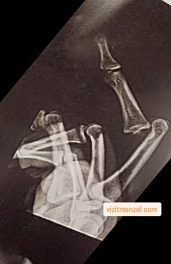 درمان شکستگی انگشت