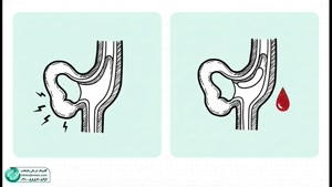 جدیدترین روش‌های درمان بواسیر -کلینیک پایتخت