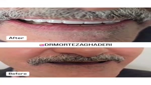 تفاوت و تغییر چهره قبل و بعد از ایمپلنت  