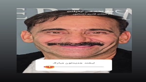 فیلم نمونه کار ایمپلنت تمام فک  