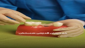 دو راه جایگزین کردن دندان از دست رفته  