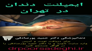 ایمپلنت دندان خانم داوودی در کلینیک دکتر حمید پورصادقی