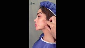 سوپر لیفت صورت و گردن خانم 40 ساله
