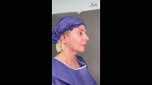 سوپر لیفت صورت و گردن خانم 58 ساله به روش دیپ پلین