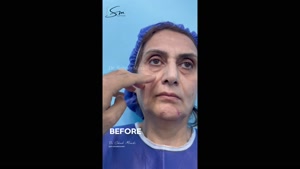 رضا المرأة الجميلة عن عملية شد الوجه والرقبة