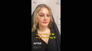 عملية شد الوجه والرقبة - بعد 15 يومًا من الجراحة