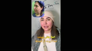 بعد 5 أشهر من جراحة شد الوجه والرقبة العميقة