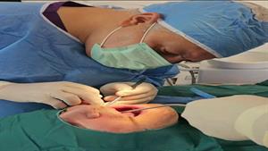 کاشت دندان دائمی آقای شکوری توسط دکتر حمید پورصادقی