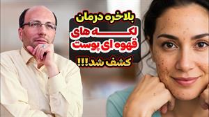 درمان لکه های قهوه ای پوست