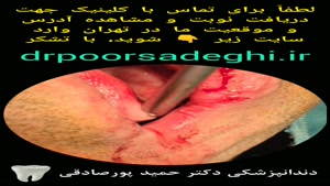 ایمپلنت دوم آقای عباسی توسط دکتر حمید پورصادقی