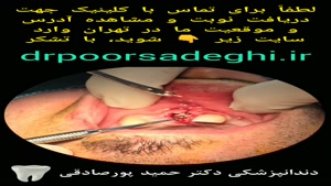 ایمپلنت اول آقای غریبی در کلینیک دکتر پورصادقی