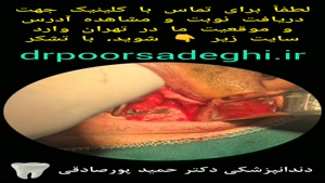 ایمپلنت اول آقای عباسی در کلینیک دکتر حمید پورصادقی