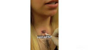 عفونت شدید میکرودرمال