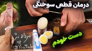 درمان سوختگی با روغن تخم مرغ