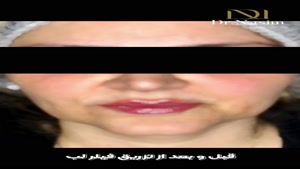 قبل و بعد از تزریق 0.8سی‌سی فیلر لب از برند فرانسوی سیتوسیال