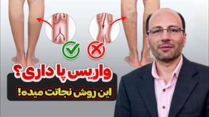 درمان فوری واریس پا با راهکار ساده