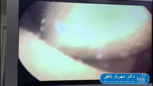 عمل جراحی سنگ بزرگ مثانه