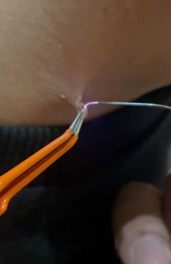 برداشتن ضایعات پوستی با دستگاه پزشکی Plasma Surgical