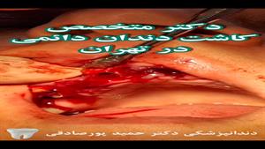 دکتر متخصص کاشت دندان دائمی در تهران-مطب دکتر حمید پورصادقی