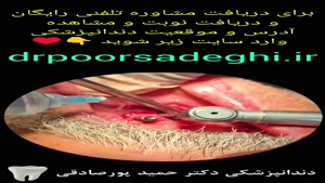 کاشت دندان دائمی اقساطی در تهران توسط دکتر حمید پورصادقی