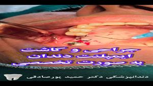 جراحی و کاشت ایمپلنت به صورت تخصصی در تهران 