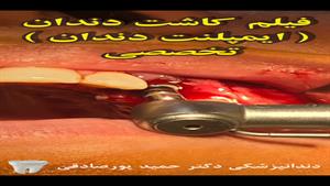 فیلم کاشت دندان (ایمپلنت دندان) کلینیک دکتر حمید پورصادقی
