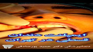 ایمپلت دندان قسطی در تهران در مطب دکتر حمید پورصادقی