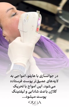 نمونه تزریق فیلر در کلینیک الگا