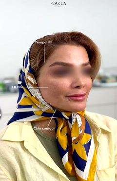 نمونه تزریق فیلر