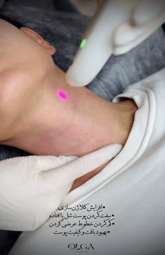 لیزر فوتونا