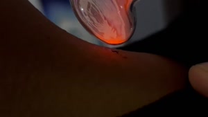 بهبود جای زخم با دستگاه پزشکی پلاسماالکتروسرجیکال