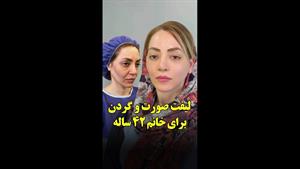 لیفت صورت و گردن به روش دیپ پلین برای خانم 42 ساله