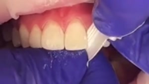 فیلم کامپوزیت دندان در کلینیک دندانپزشکی