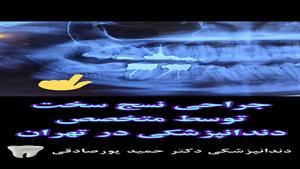 جراحی نسج سخت توسط متخصص دندانپزشکی در تهران