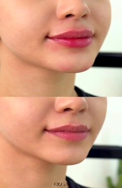 فیلر لب طبیعی و نچرال