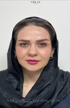 تاثیر لیز فوتونا بر لیفت ابرو