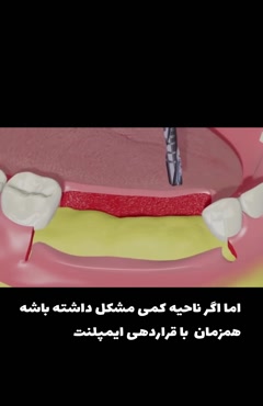 بهترین نوع کاشت ایمپلنت دندان - دکتر ایمپلنت 