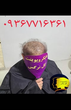 ترمیم مو به روش مایکروپوینت 