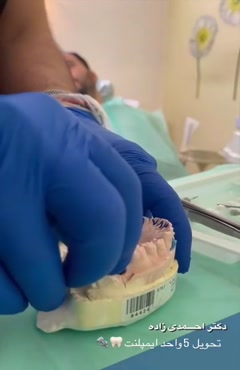 مراحل نهایی ایمپلنت 