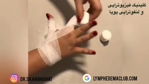 چطور لنف ادم دست را بانداژ کنیم؟ 