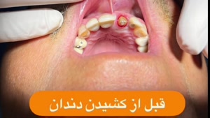 جایگزین یک روزه دندان کشیده  شده  