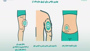 روش تزریق اسپارتینا