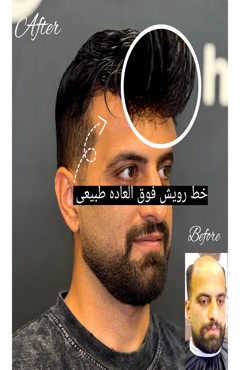 پروتز مو سریع ترین روش درمان طاسی 09967076737