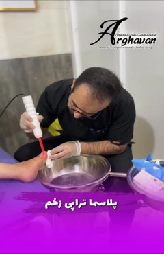 درمان زخم با پلاسما الکتروسرجیکال