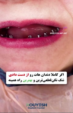 ایمپلنت فک بالا و پایین 