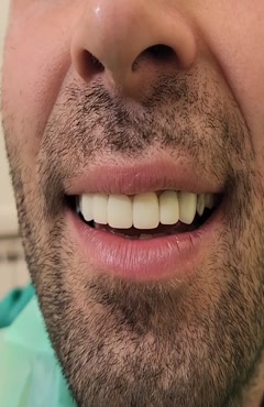 روکش و ایمپلنت با هم برای زیبایی  