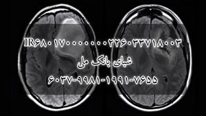 کمک فوری یه یک بیمار سرطان مغز جهت شیمی درمانی 